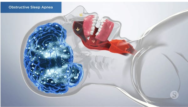 Custom oral sleep appliance