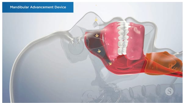A custom oral sleep appliance
