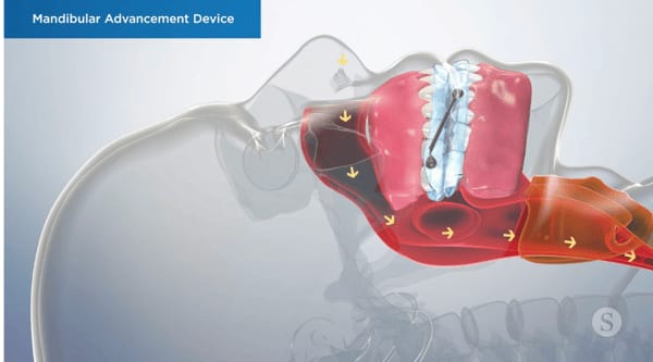Custom oral sleep appliance